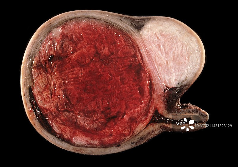 子宫肌瘤图片素材