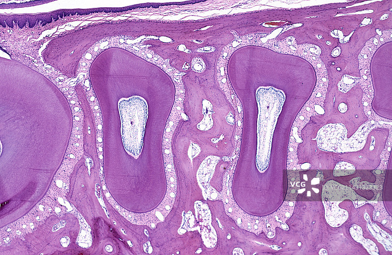 阻生齿图片素材
