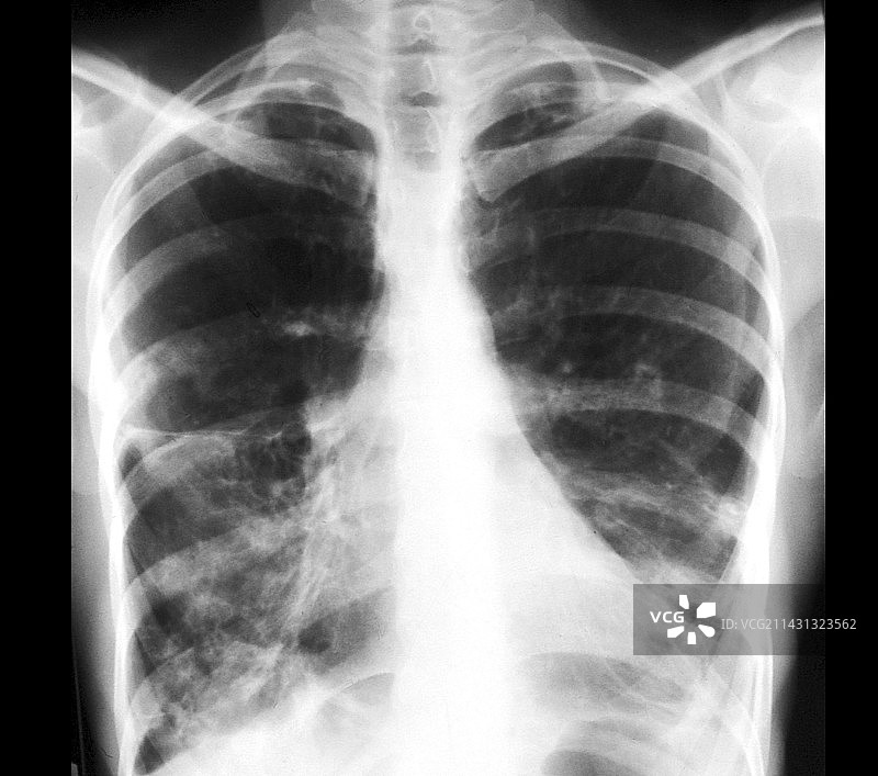 肺结核X光片图片素材