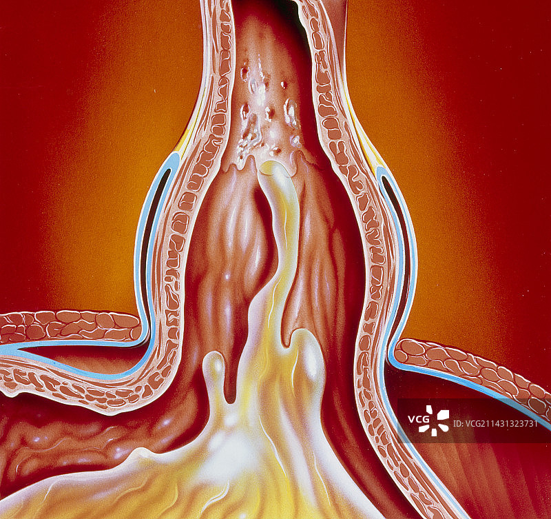 食管裂孔疝胃食管反流艺术图片素材