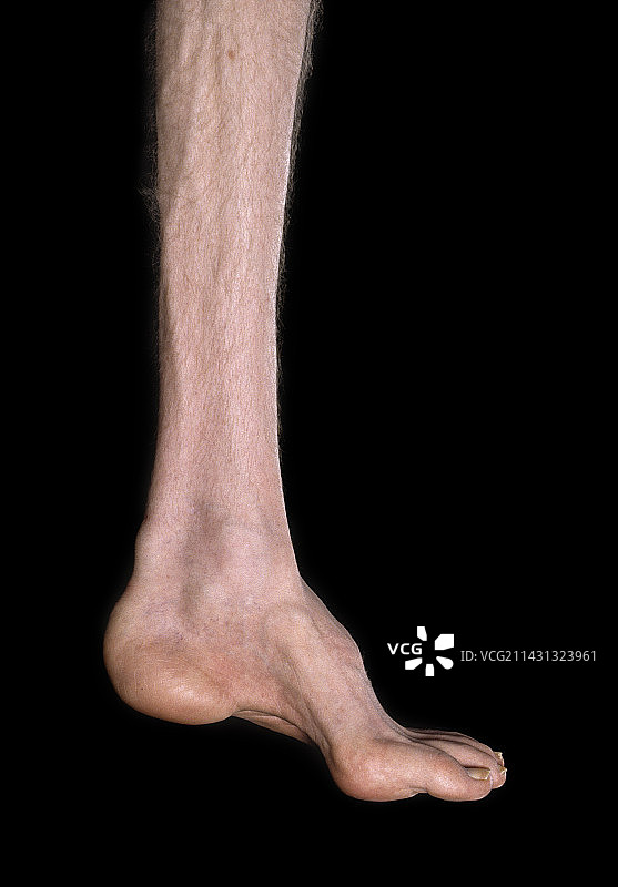 腓骨肌萎缩症图片素材