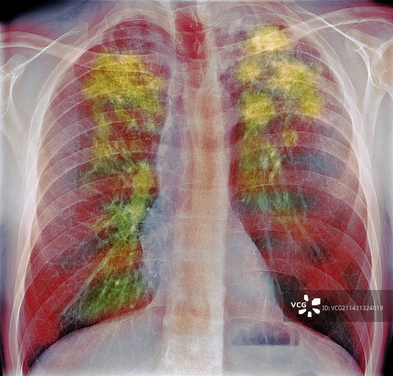 肺结节病，X光片图片素材