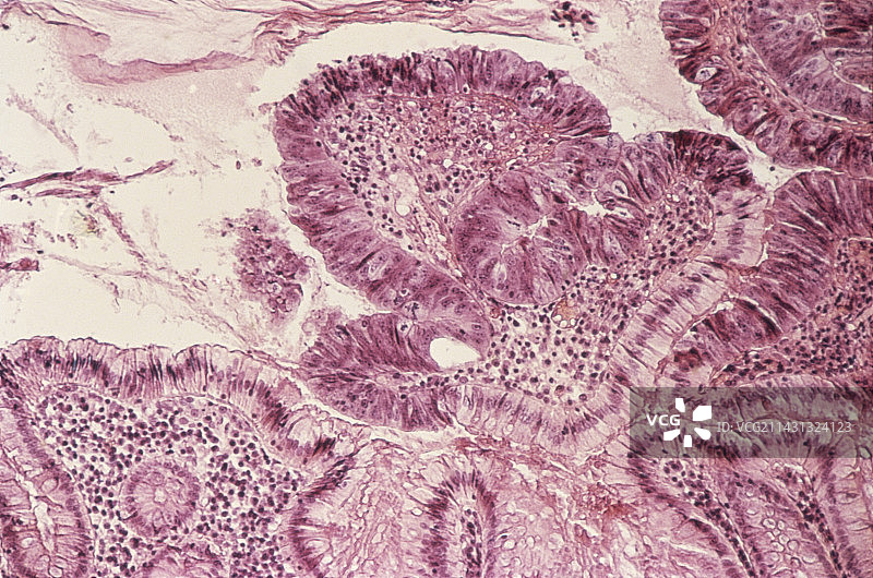 结肠癌图片素材
