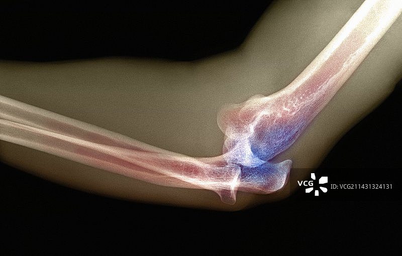 肘关节脱位X光片图片素材