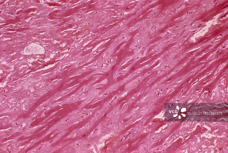 心脏淀粉样变性，光学显微照片图片素材