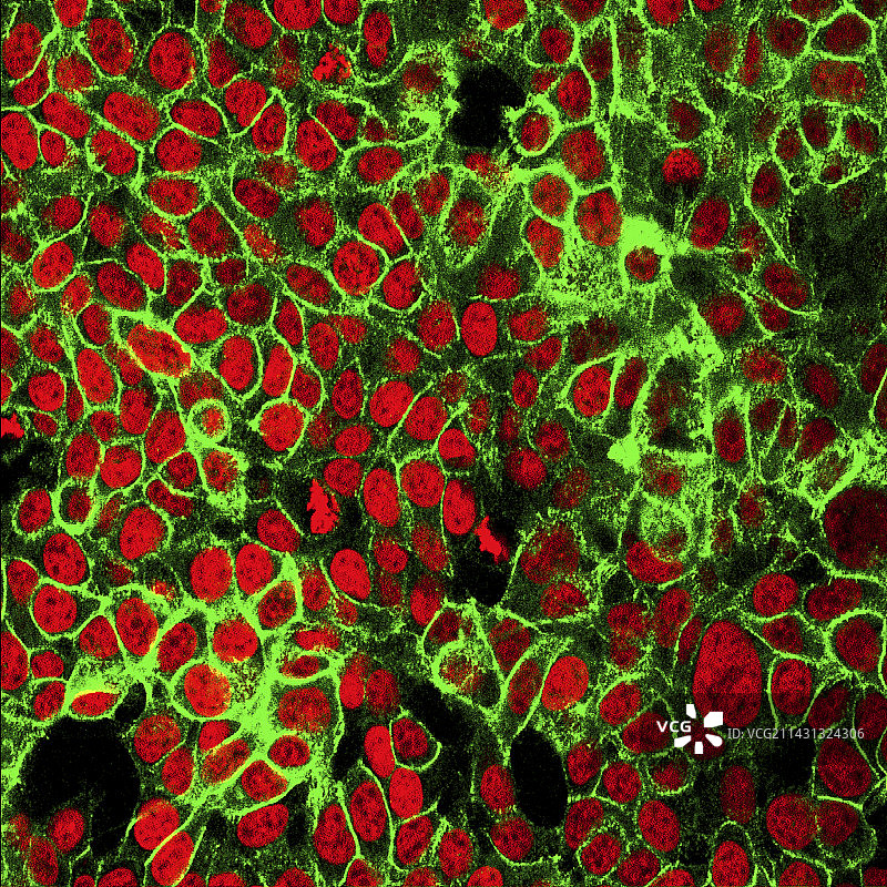 结肠癌细胞图片素材