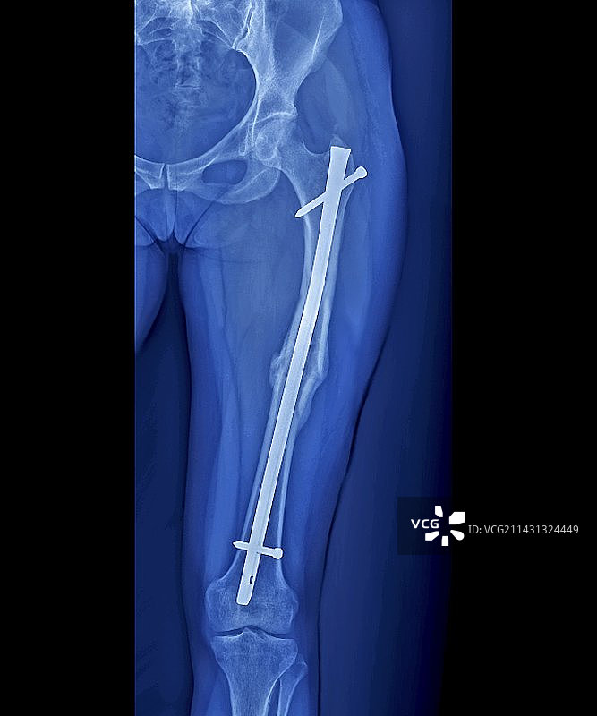 图钉固定的骨折腿部X光片图片素材