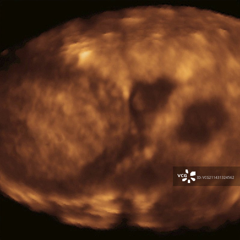 异位妊娠超声波扫描图片素材