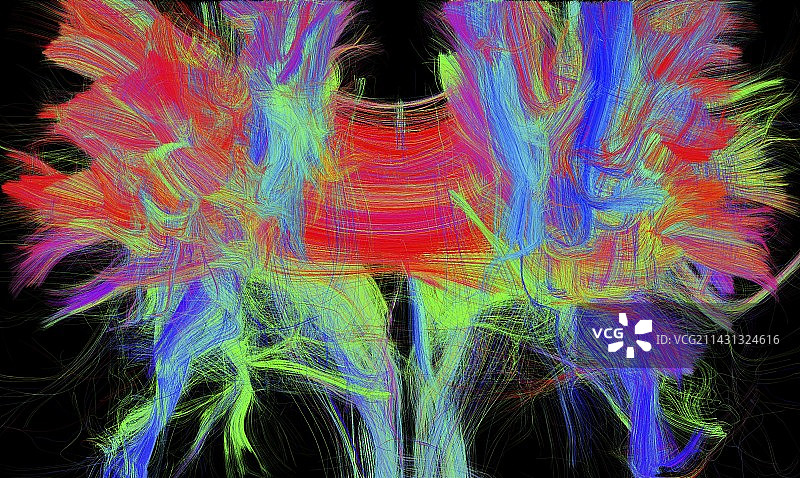 胼胝体DTI核磁共振扫描图片素材