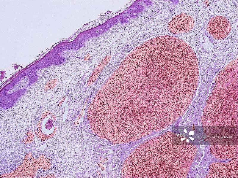 淋巴瘤，光学显微照片图片素材
