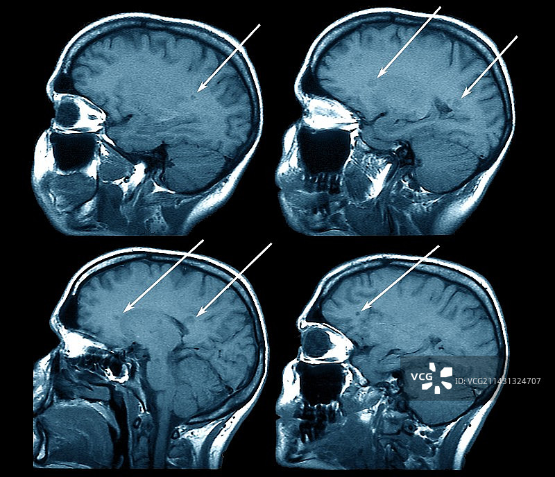 多发性硬化症核磁共振扫描图片素材