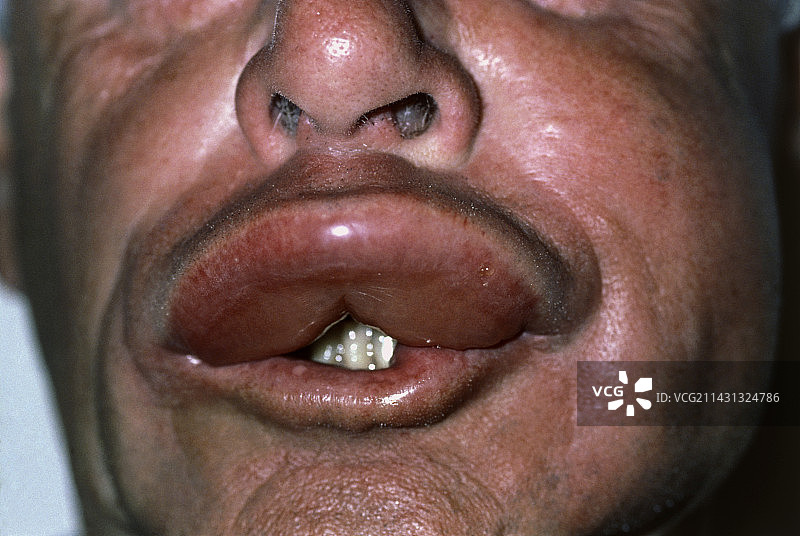 嘴唇上的黄蜂蜇伤图片素材