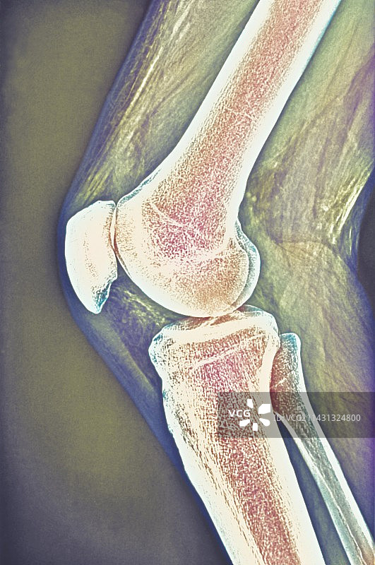 膝关节X光片图片素材