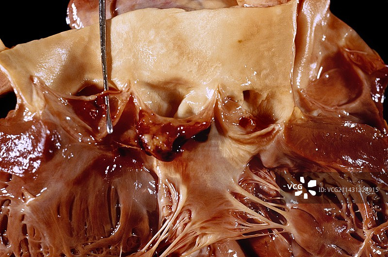 感染性心内膜炎图片素材