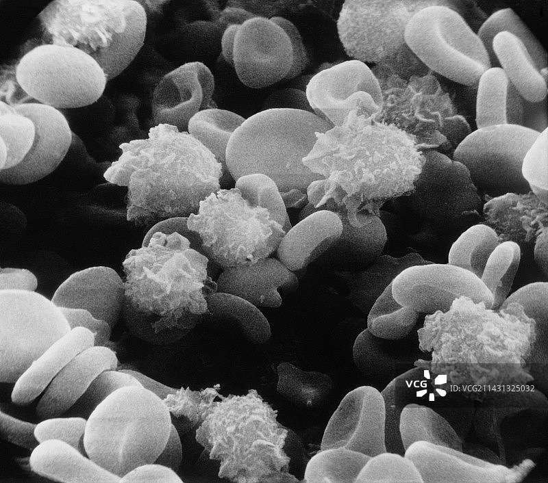 毛细胞白血病图片素材