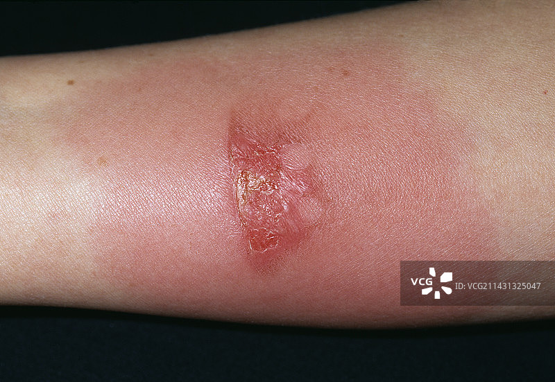 感染烧伤图片素材