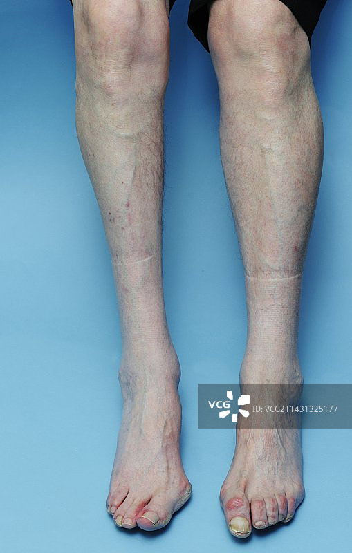 腿部脊髓灰质炎图片素材