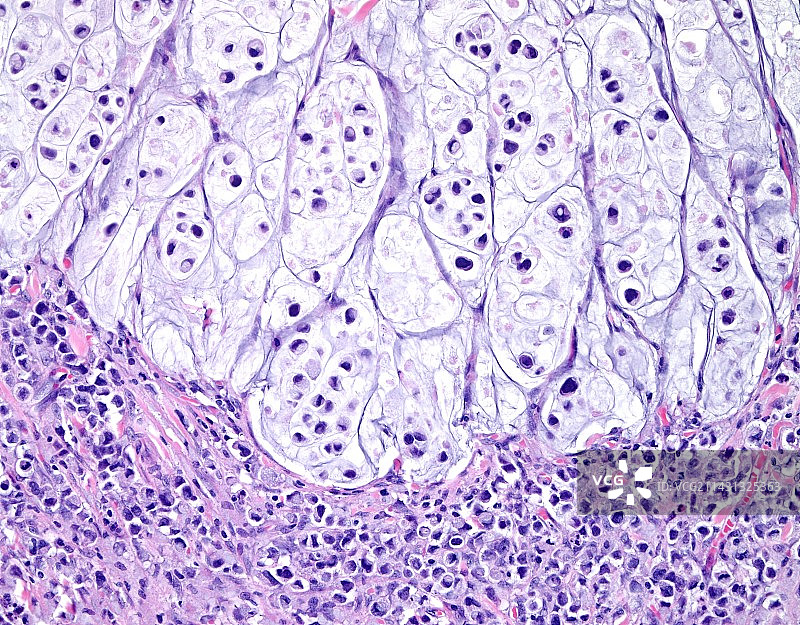 结肠印戒细胞癌的光学显微照片图片素材