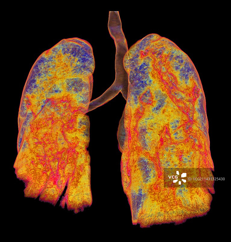 受新冠影响的肺部非典型肺炎3D CT扫描图片素材