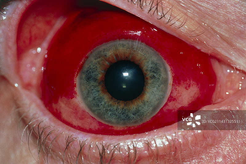 眼部特写：结膜下出血图片素材