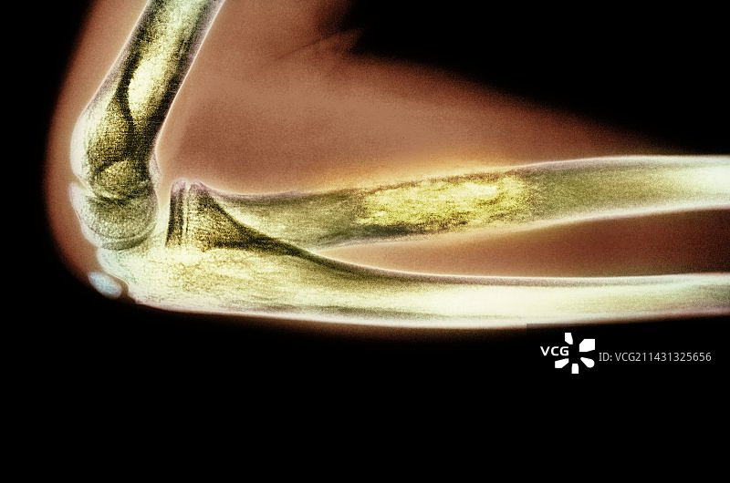 尤文氏肉瘤X光片图片素材