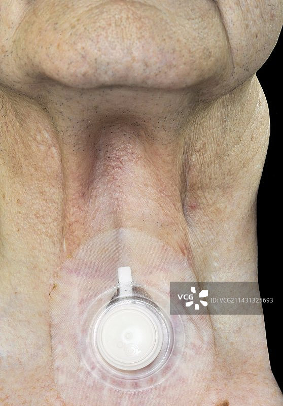 气管切开术图片素材