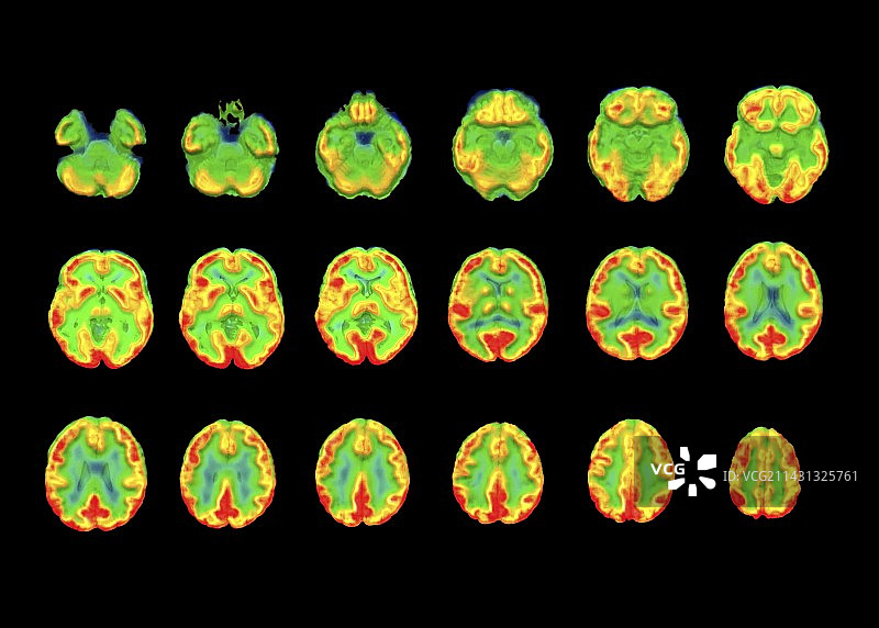 阿尔茨海默病患者的大脑SPECT图像图片素材