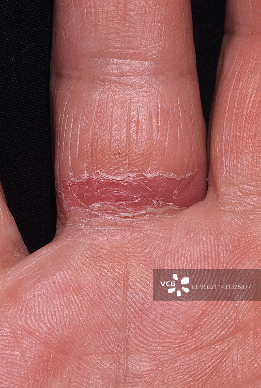 戒指过敏图片素材