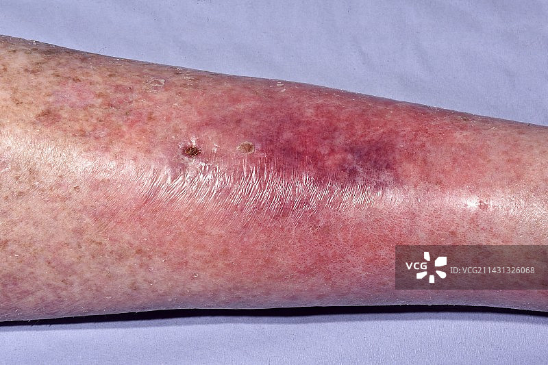 腿部蜂窝组织炎图片素材