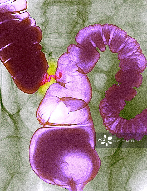 结肠痉挛X光片图片素材