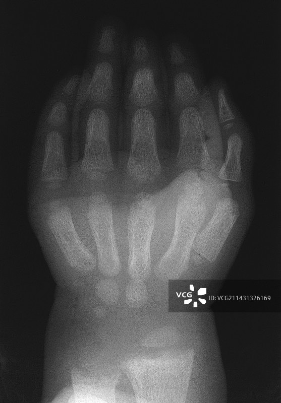 患佝偻病儿童的手腕X光片图片素材