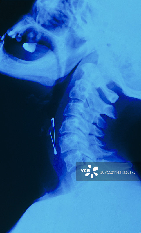 喉部别针异物X光片图片素材