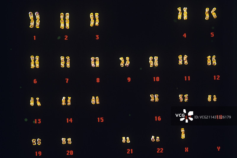 特纳综合征核型图片素材