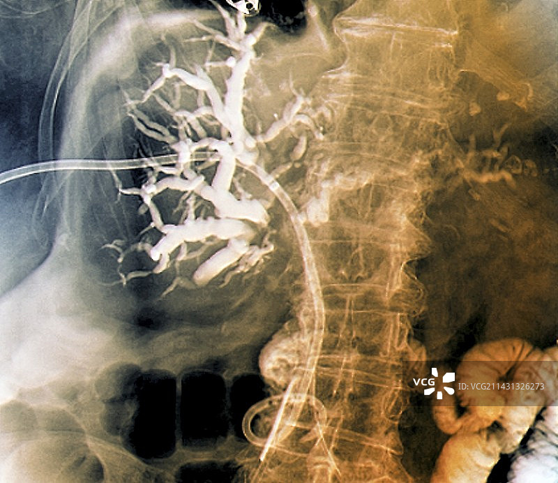 胆道引流X光片图片素材