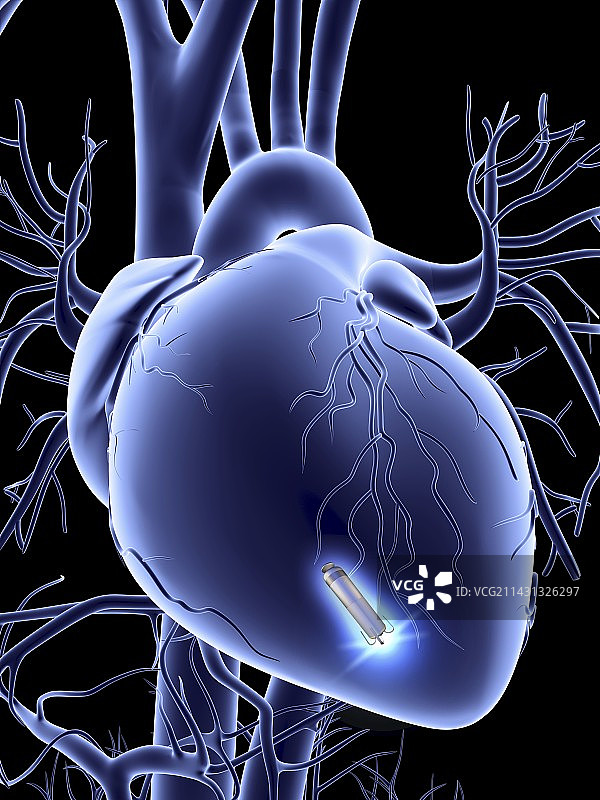 带有无导线心脏起搏器的心形图片素材