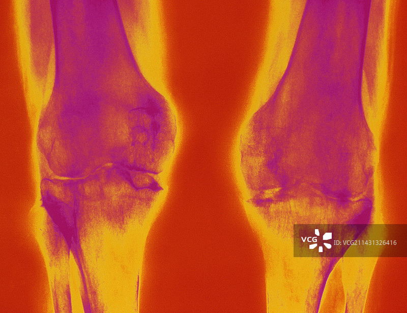 关节炎膝盖图片素材
