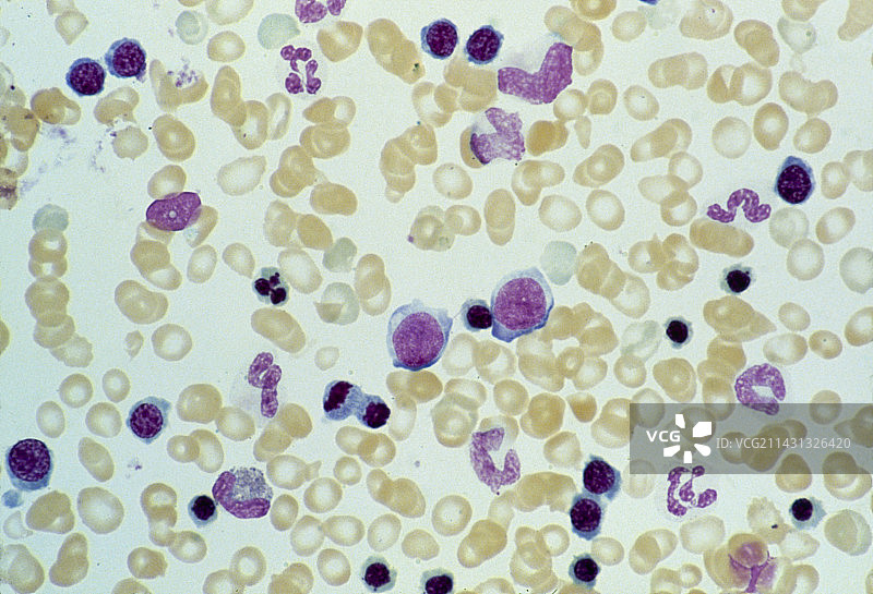 慢性白血病患者的骨髓LM图片素材