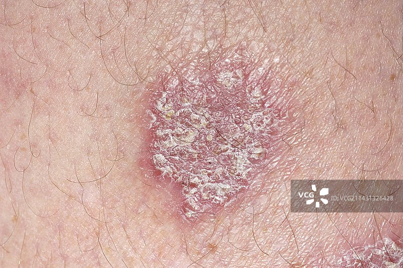慢性斑块状银屑病图片素材