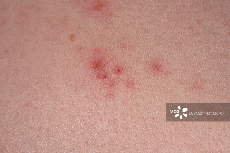 手足口病图片素材