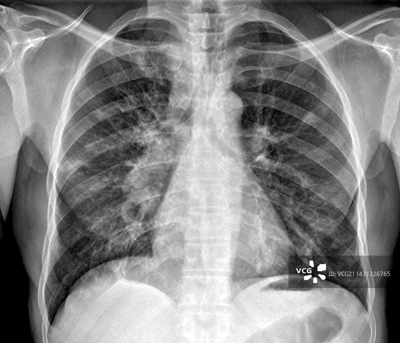 结核性肺炎X光片图片素材