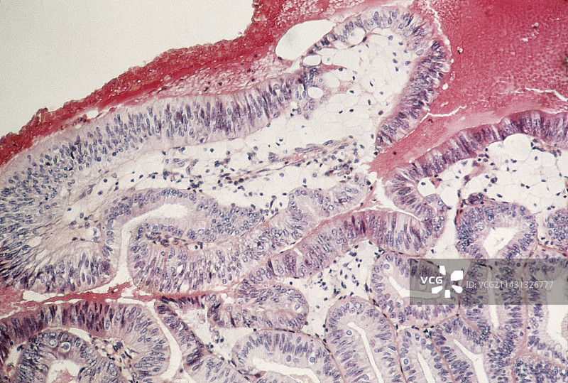 子宫癌图片素材