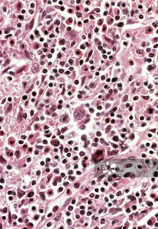 霍奇金病，光学显微照片图片素材