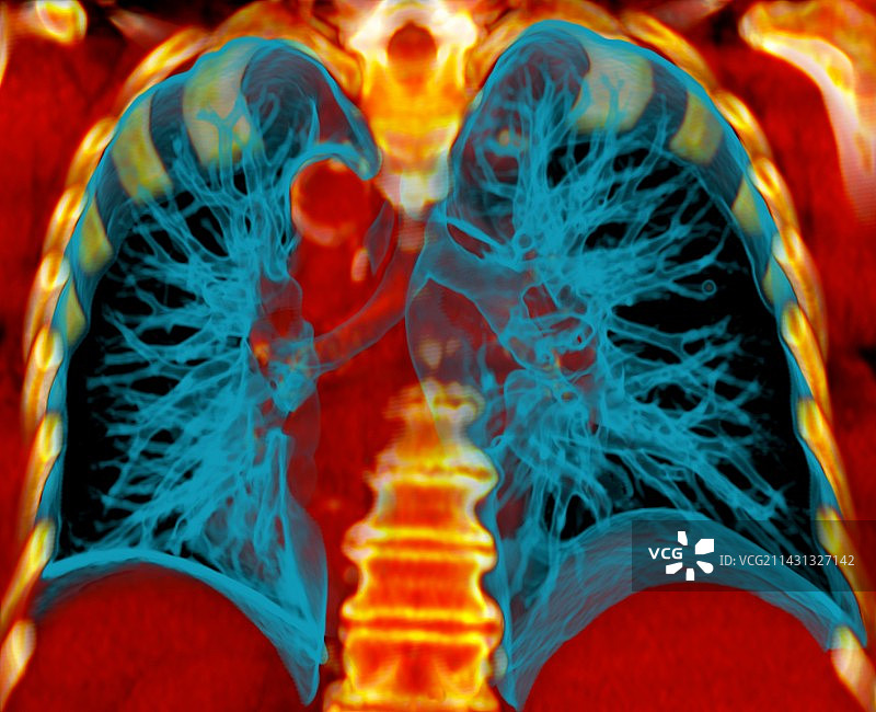 健康的肺部CT扫描图片素材