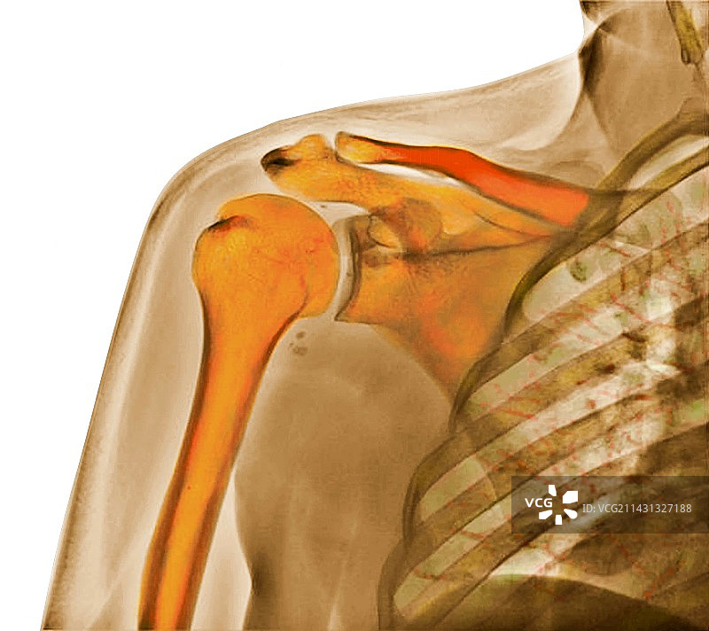 肩关节X光片图片素材