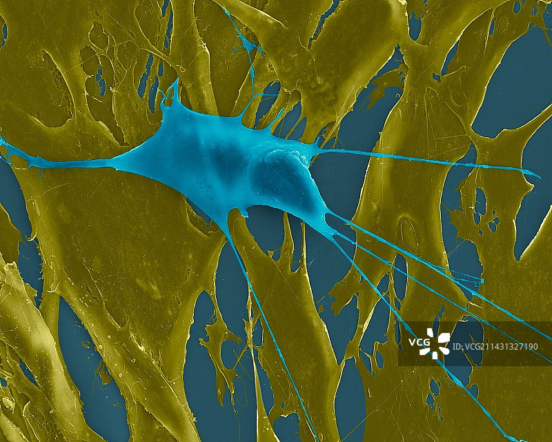 健康成纤维细胞中的肺成纤维细胞癌细胞，SEM图片素材