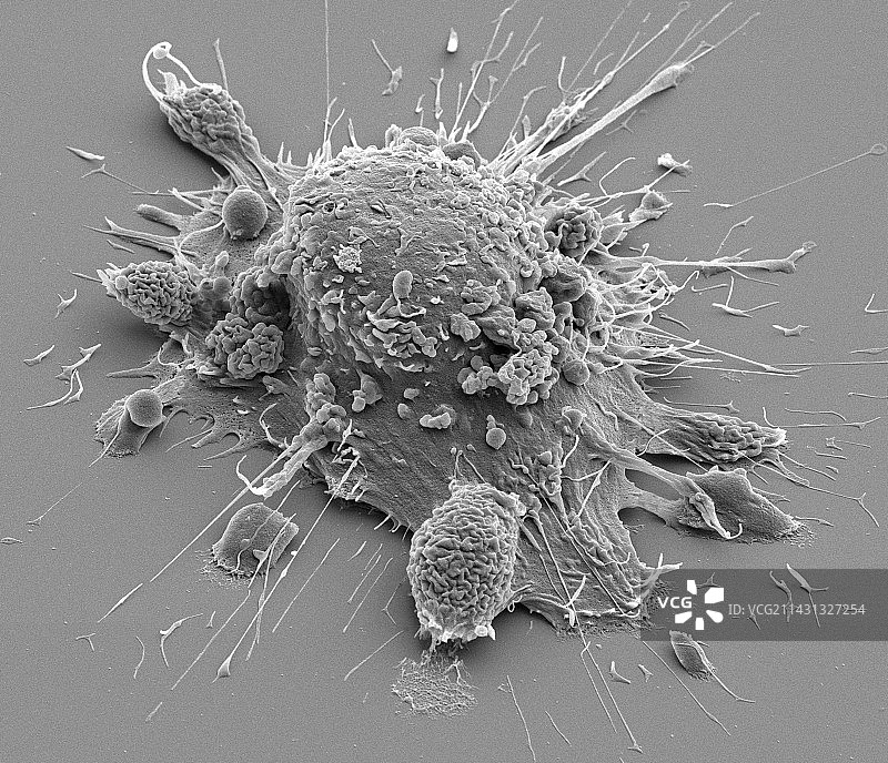 口腔癌细胞扫描电镜图图片素材