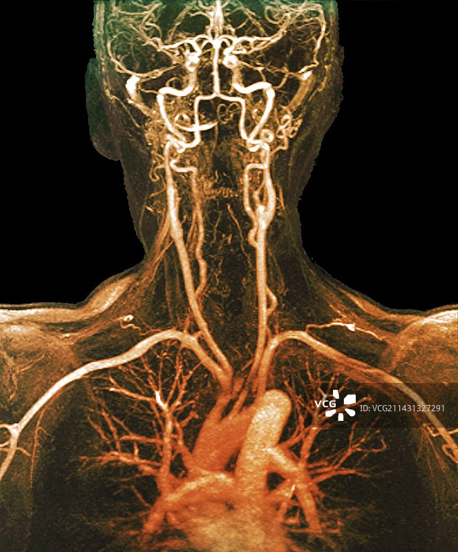 胸部，颈部和头部动脉，核磁共振血管造影图片素材