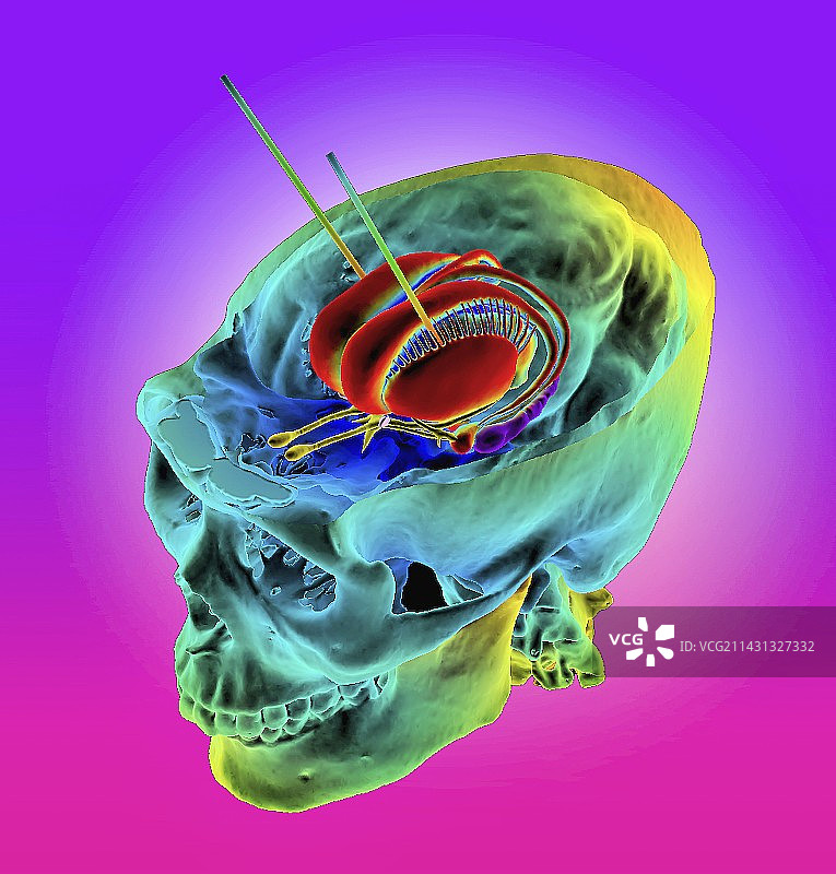基于3D CT图像的脑深部刺激图片素材