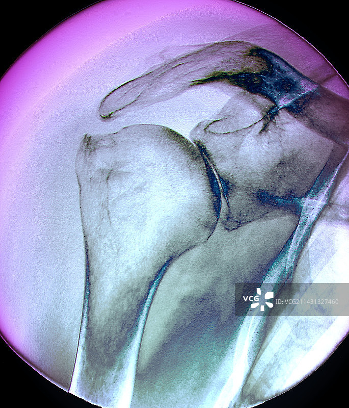 关节炎肩部X光片图片素材