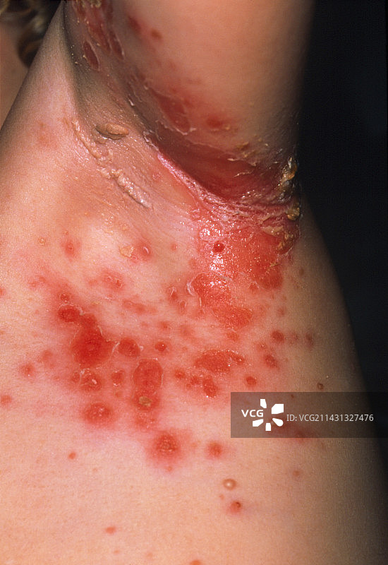 腋窝患有脓疱病的儿童图片素材
